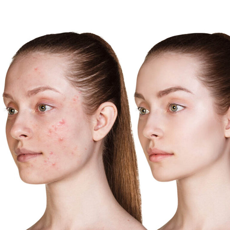 High frequency for acne Skin Laser Clinic